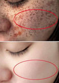 سفید کننده ی دایمی و ضدلک صورت