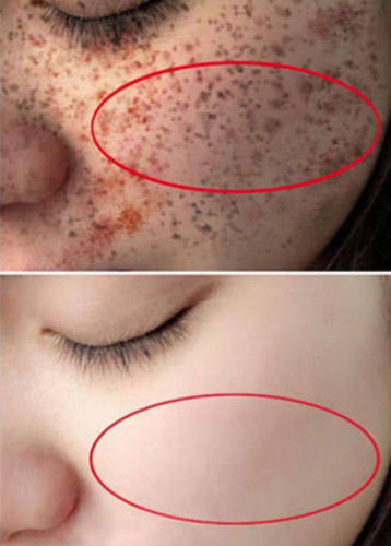 سفید کننده ی دایمی و ضدلک صورت