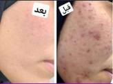 فوم شستشوی ضدجوش