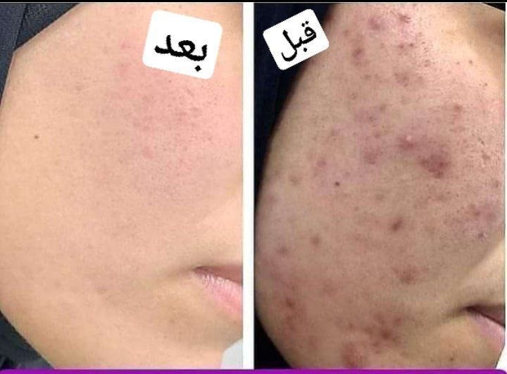 فوم شستشوی ضدجوش